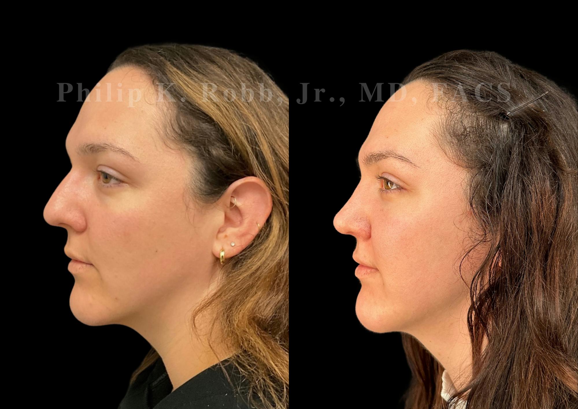 Ultrasonic Rhinoplasty Before & After Gallery - Patient 250099 - Image 5