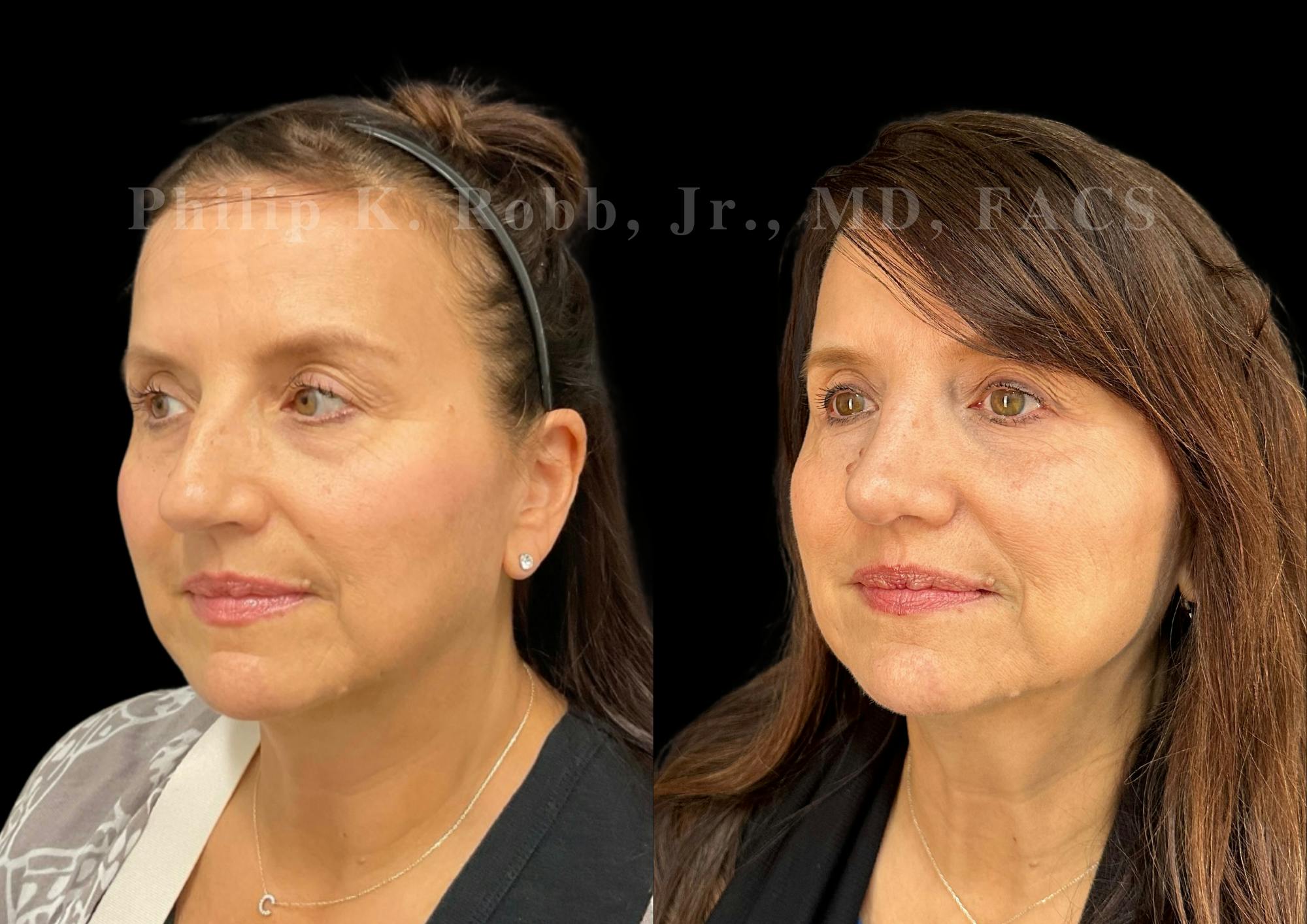 Ultrasonic Rhinoplasty Before & After Gallery - Patient 194690 - Image 4