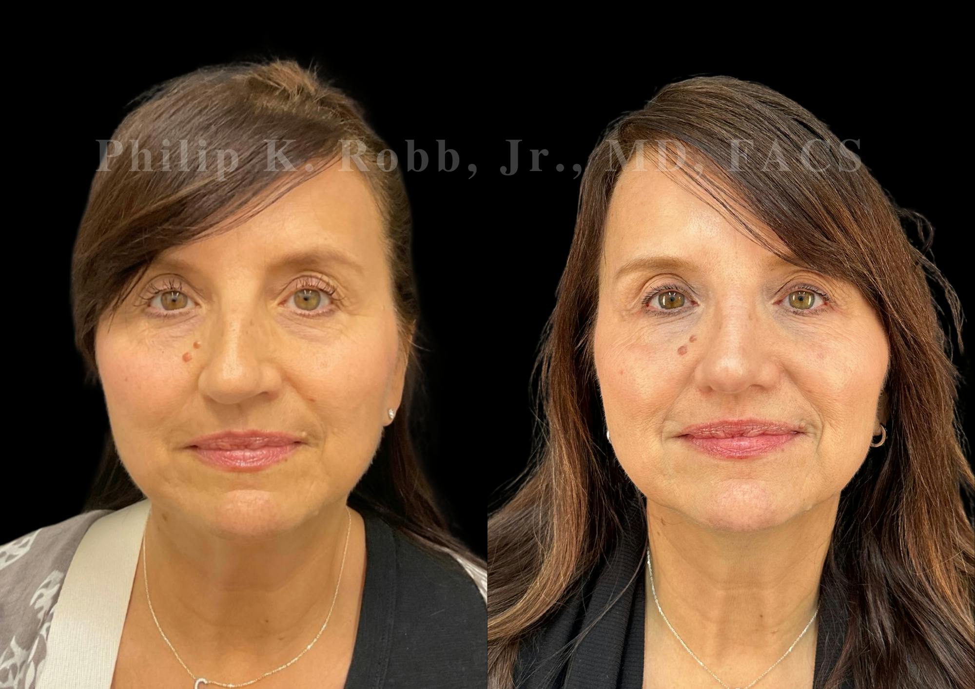 Ultrasonic Rhinoplasty Before & After Gallery - Patient 194690 - Image 3