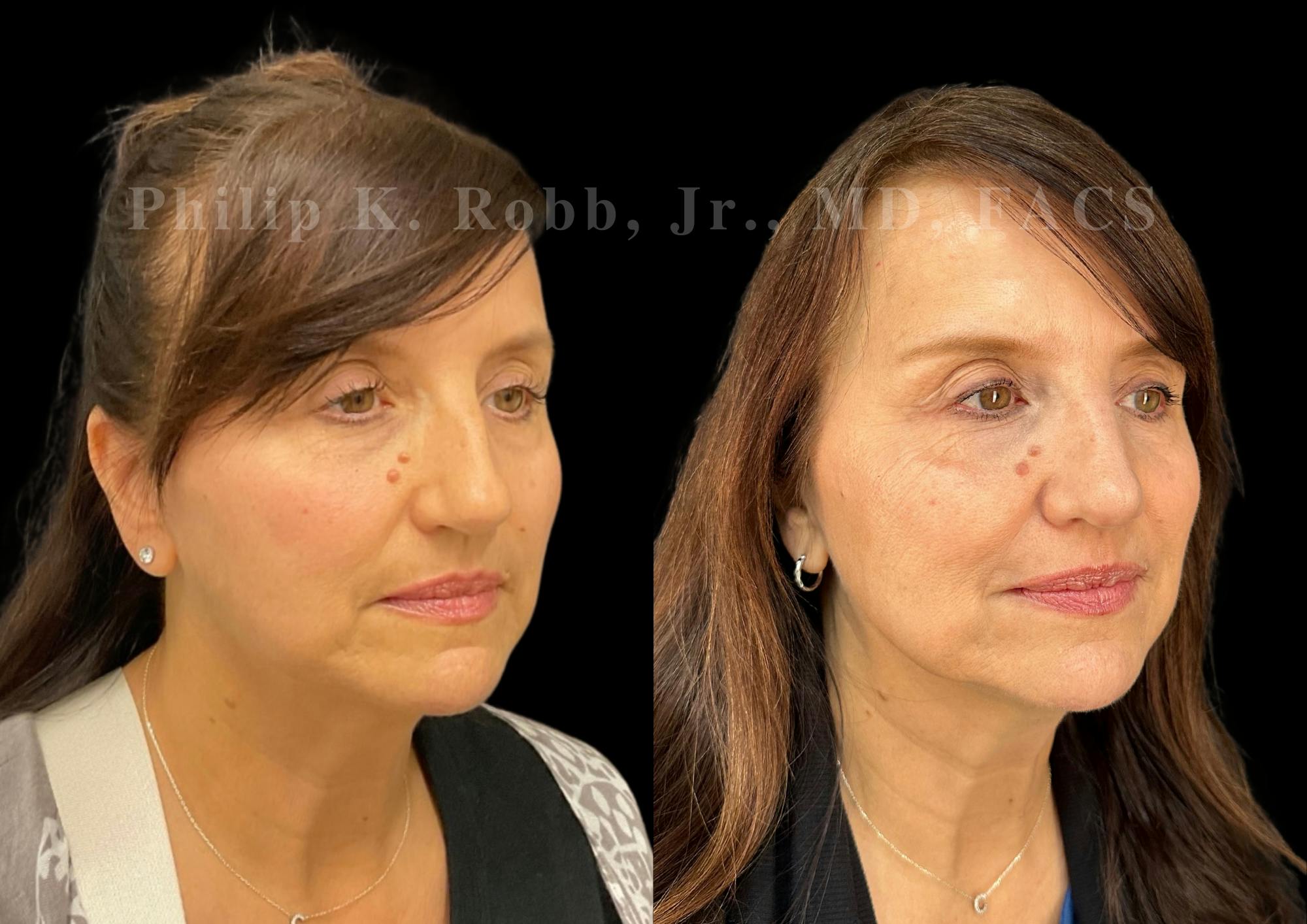 Ultrasonic Rhinoplasty Before & After Gallery - Patient 194690 - Image 2