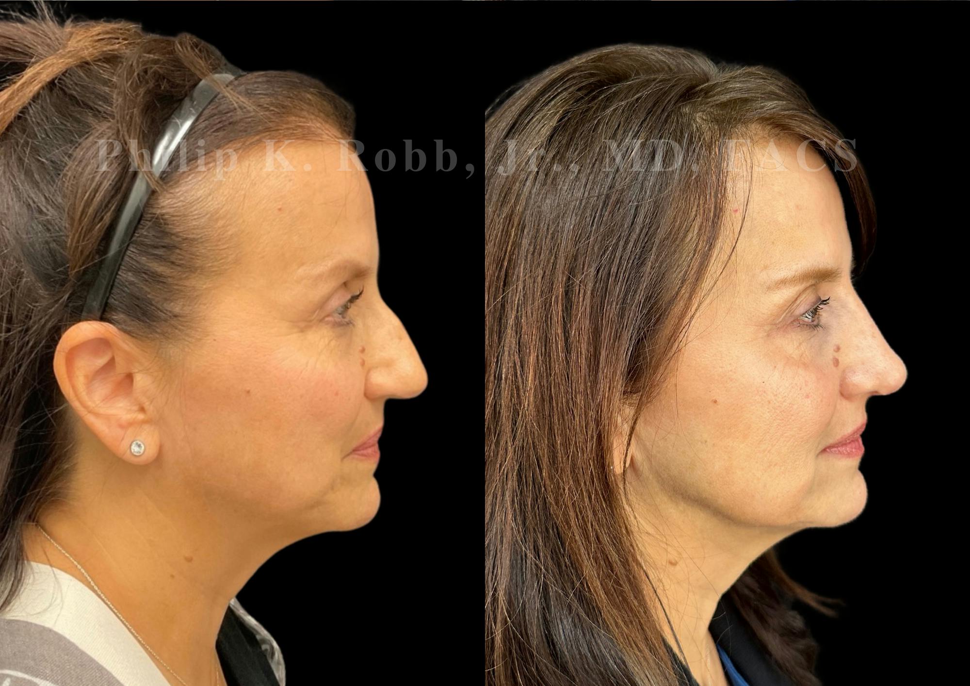 Ultrasonic Rhinoplasty Before & After Gallery - Patient 194690 - Image 1