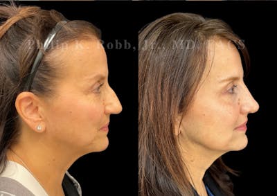 Ultrasonic Rhinoplasty Before & After Gallery - Patient 194690 - Image 1