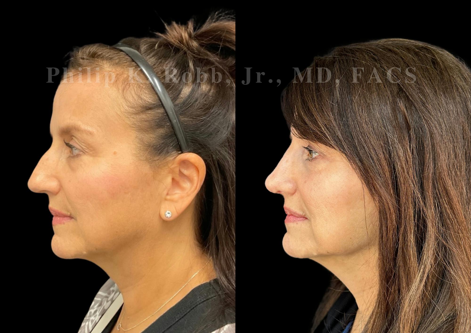 Ultrasonic Rhinoplasty Before & After Gallery - Patient 194690 - Image 5
