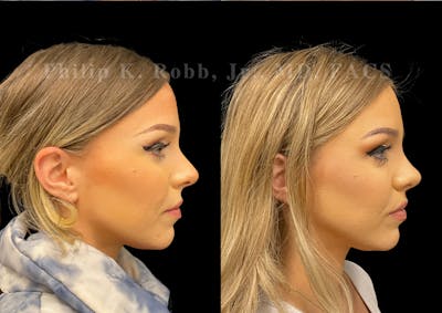 Revision Ultrasonic Rhinoplasty Before & After Gallery - Patient 929464 - Image 1