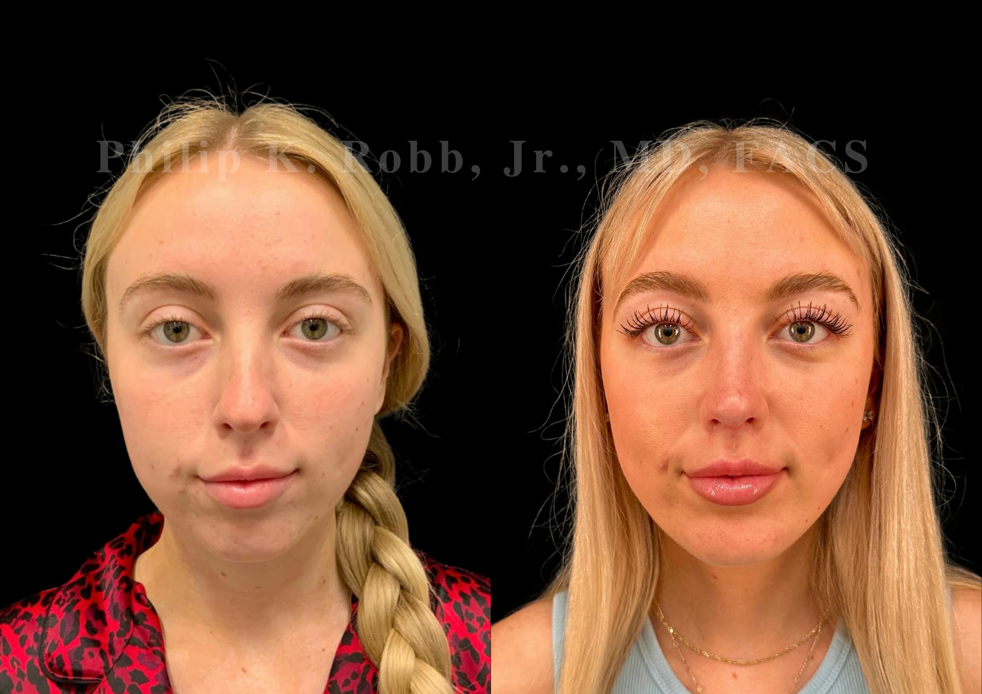 Ultrasonic Rhinoplasty Before & After Gallery - Patient 192044 - Image 3