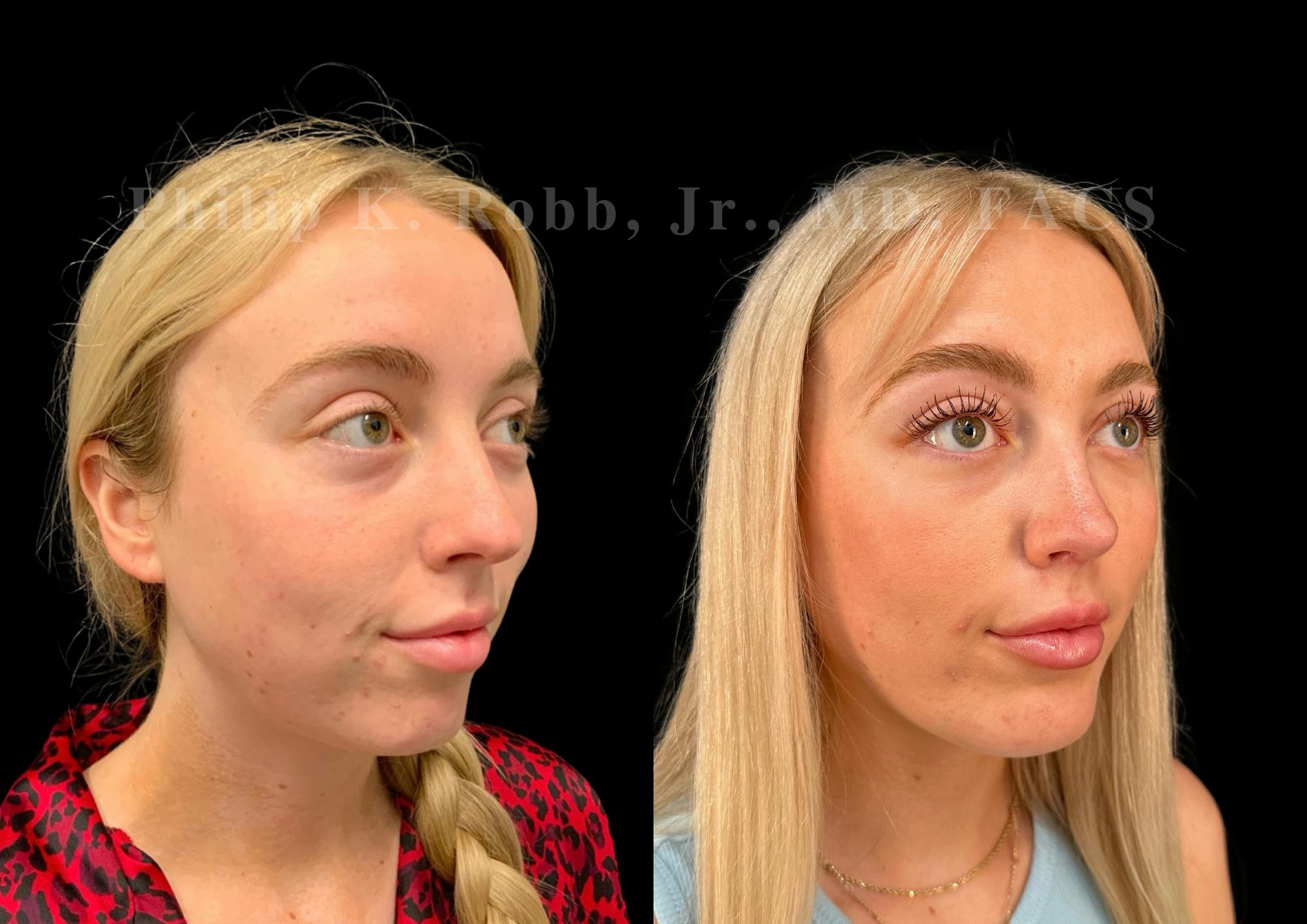 Ultrasonic Rhinoplasty Before & After Gallery - Patient 192044 - Image 2