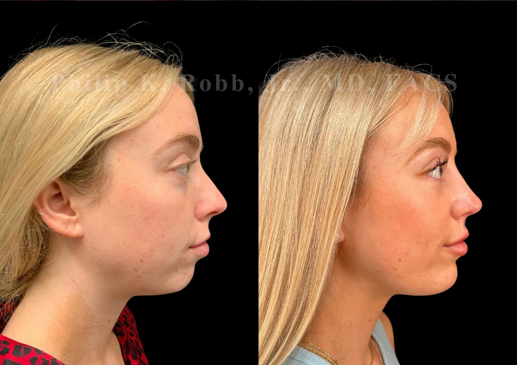 Ultrasonic Rhinoplasty Before & After Gallery - Patient 192044 - Image 1