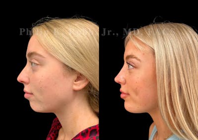 Chin Augmentation Before & After Gallery - Patient 100381 - Image 1