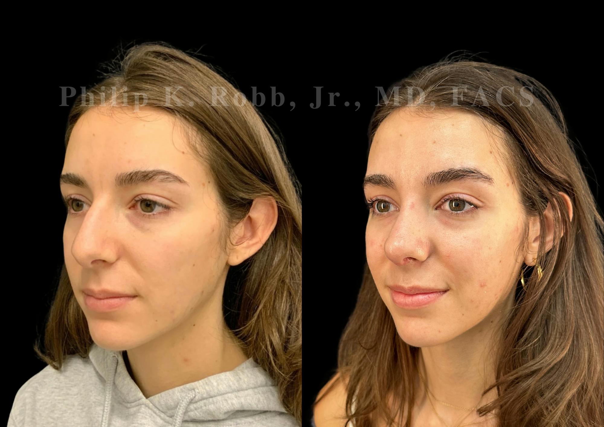 Ultrasonic Rhinoplasty Before & After Gallery - Patient 257788 - Image 4