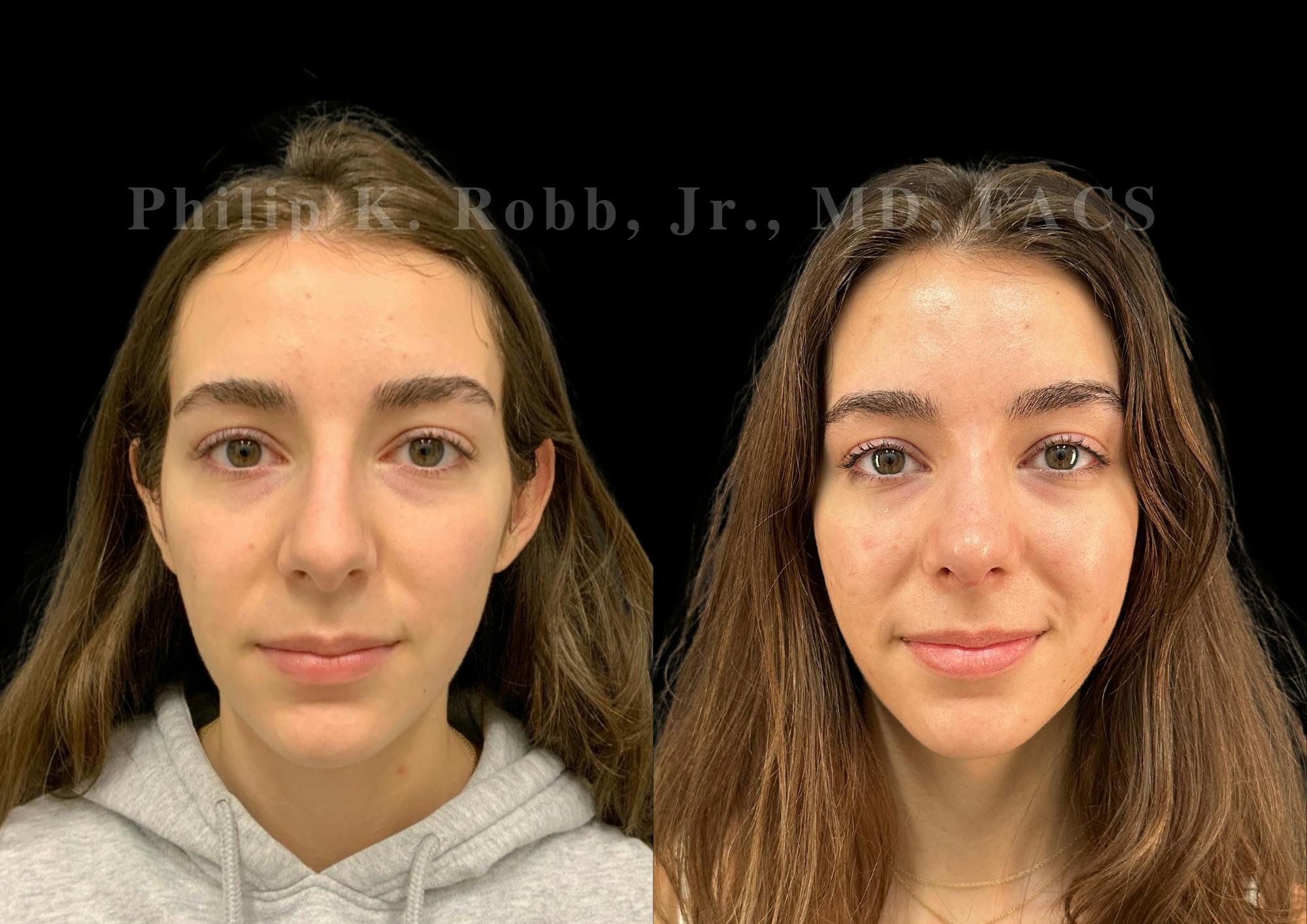 Ultrasonic Rhinoplasty Before & After Gallery - Patient 257788 - Image 3