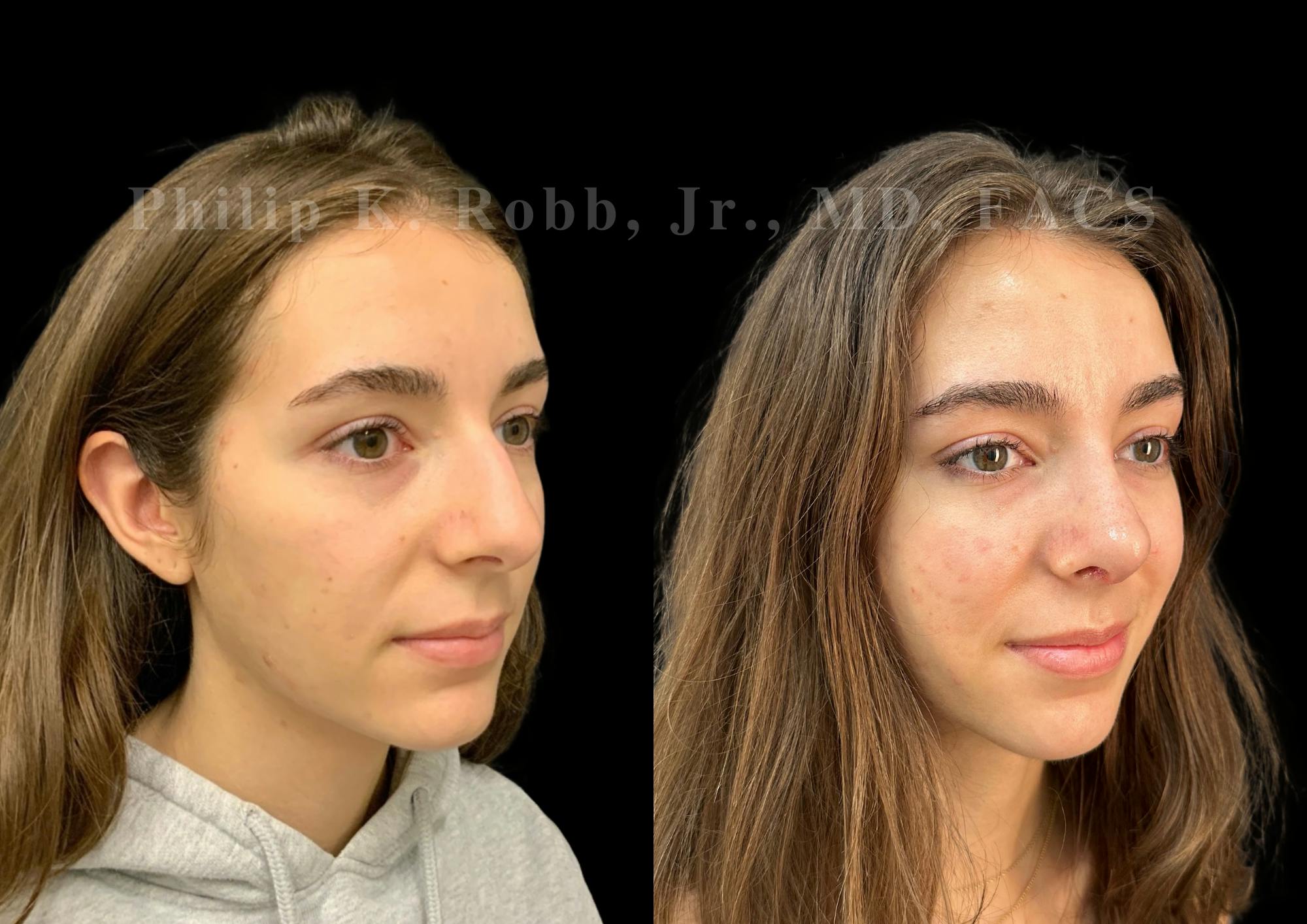 Ultrasonic Rhinoplasty Before & After Gallery - Patient 257788 - Image 2