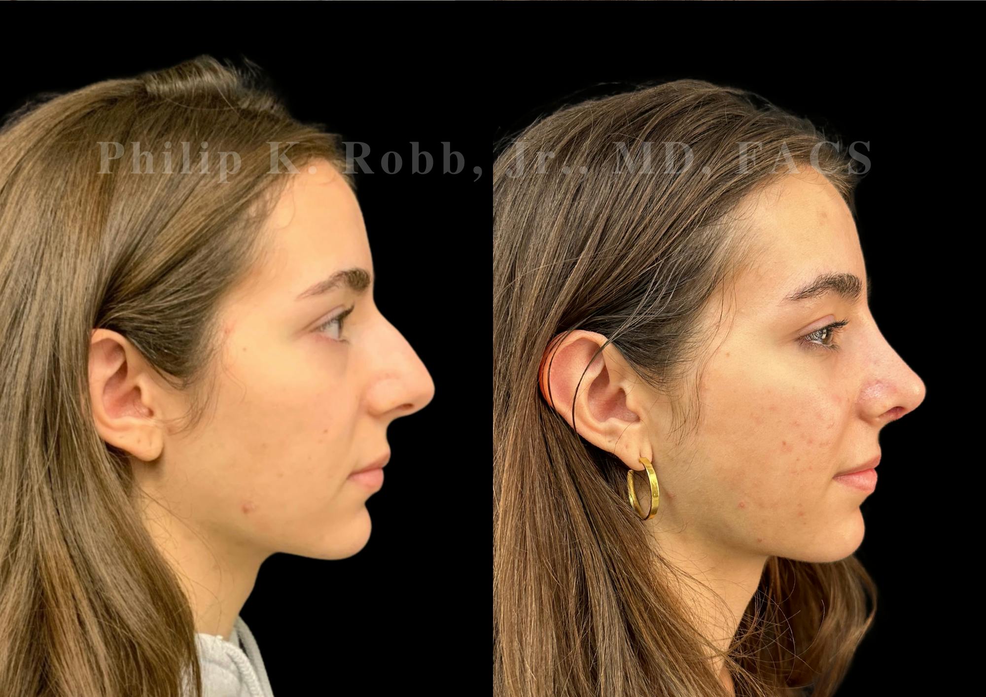 Ultrasonic Rhinoplasty Before & After Gallery - Patient 257788 - Image 1