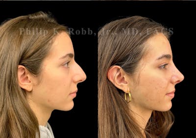 Ultrasonic Rhinoplasty Before & After Gallery - Patient 257788 - Image 1