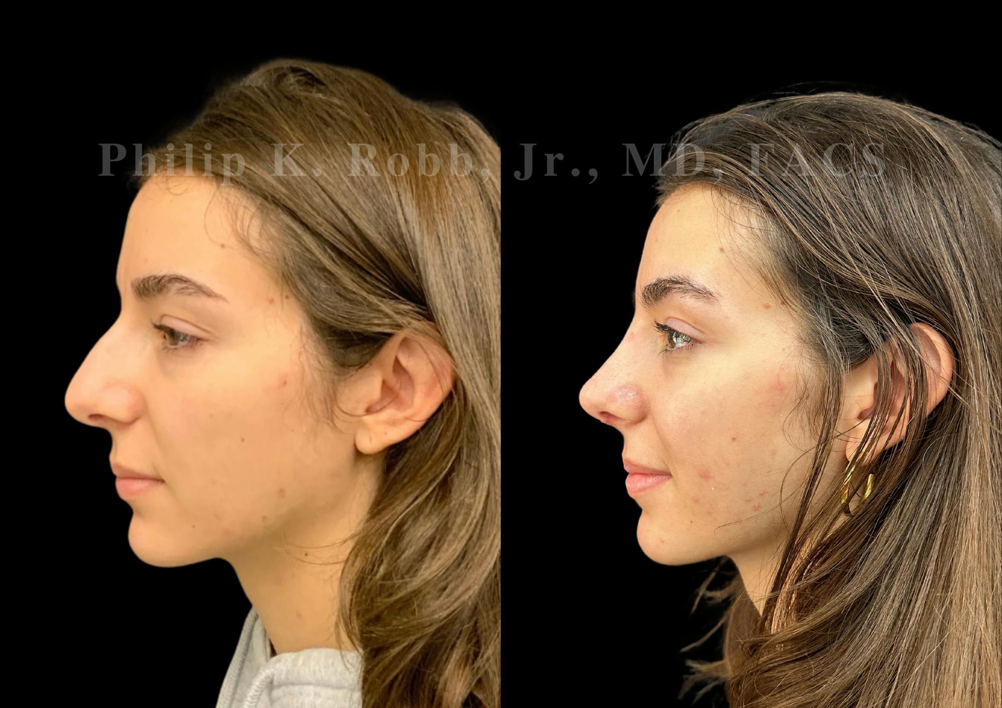 Ultrasonic Rhinoplasty Before & After Gallery - Patient 257788 - Image 5