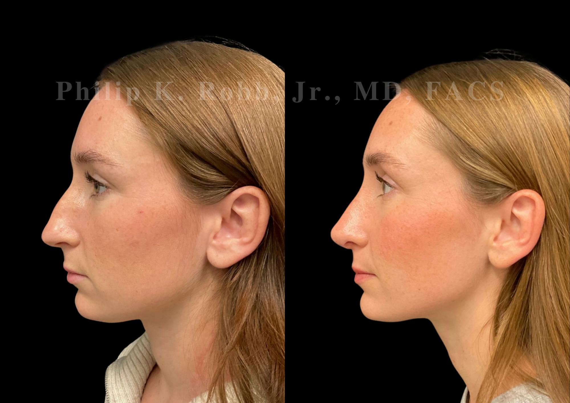 Ultrasonic Rhinoplasty Before & After Gallery - Patient 170037 - Image 5