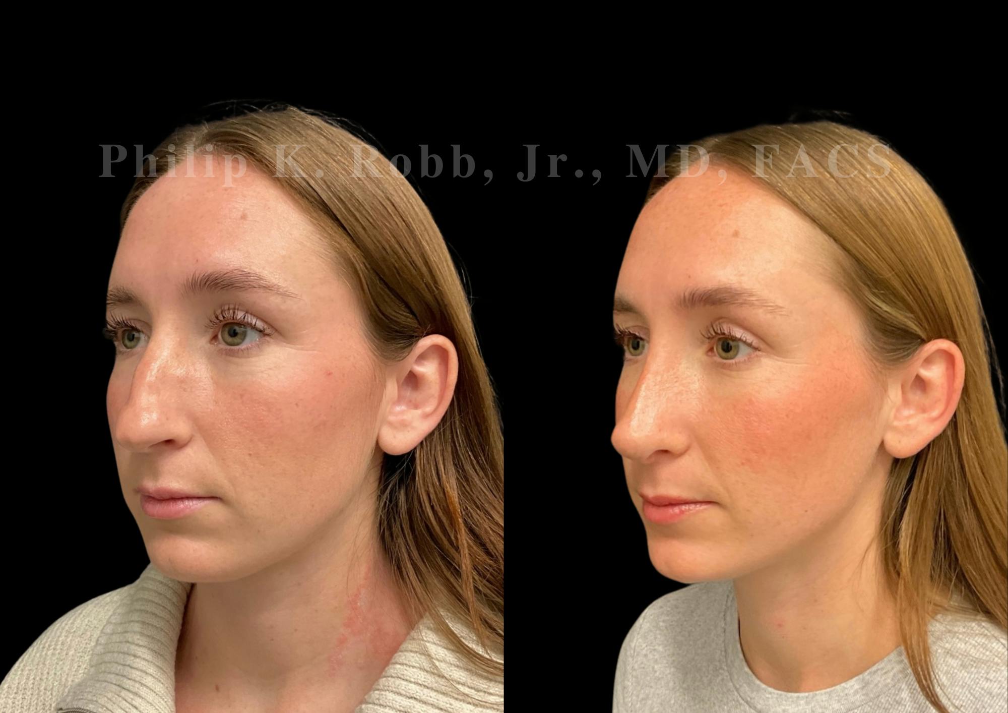 Ultrasonic Rhinoplasty Before & After Gallery - Patient 170037 - Image 4