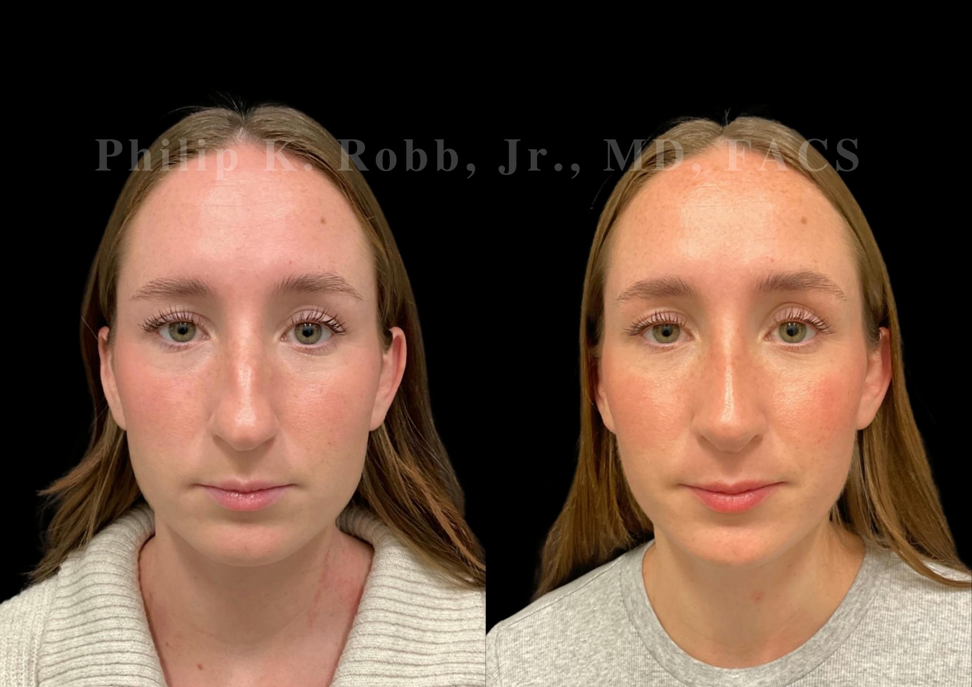 Ultrasonic Rhinoplasty Before & After Gallery - Patient 170037 - Image 3