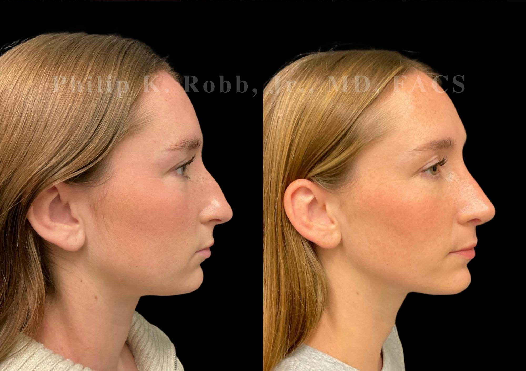 Ultrasonic Rhinoplasty Before & After Gallery - Patient 170037 - Image 1