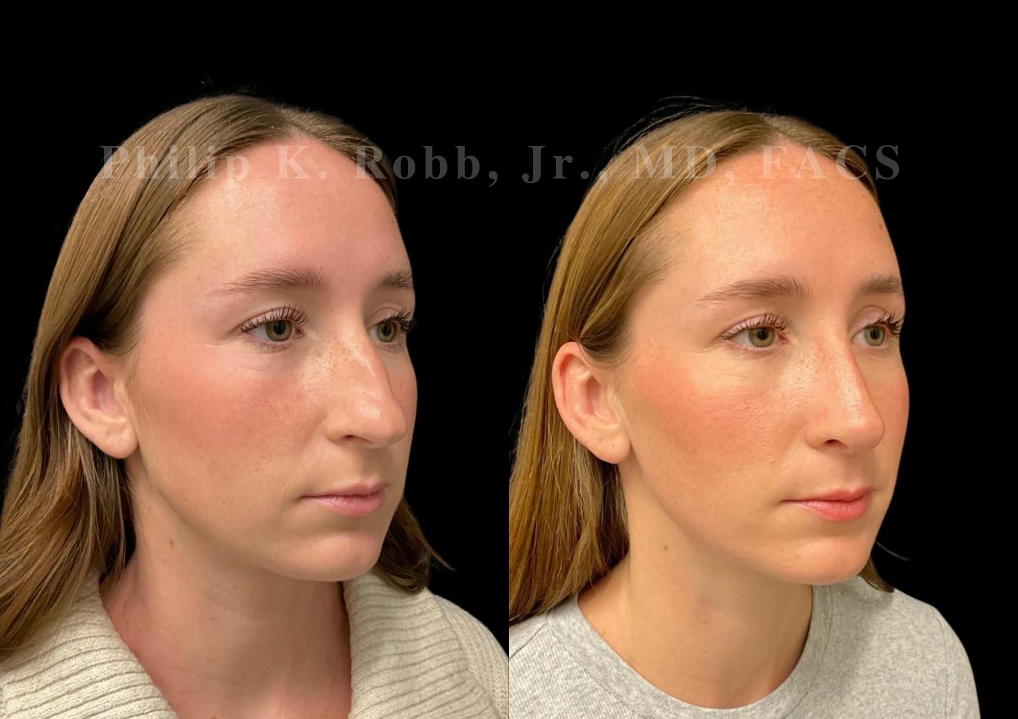 Ultrasonic Rhinoplasty Before & After Gallery - Patient 170037 - Image 2