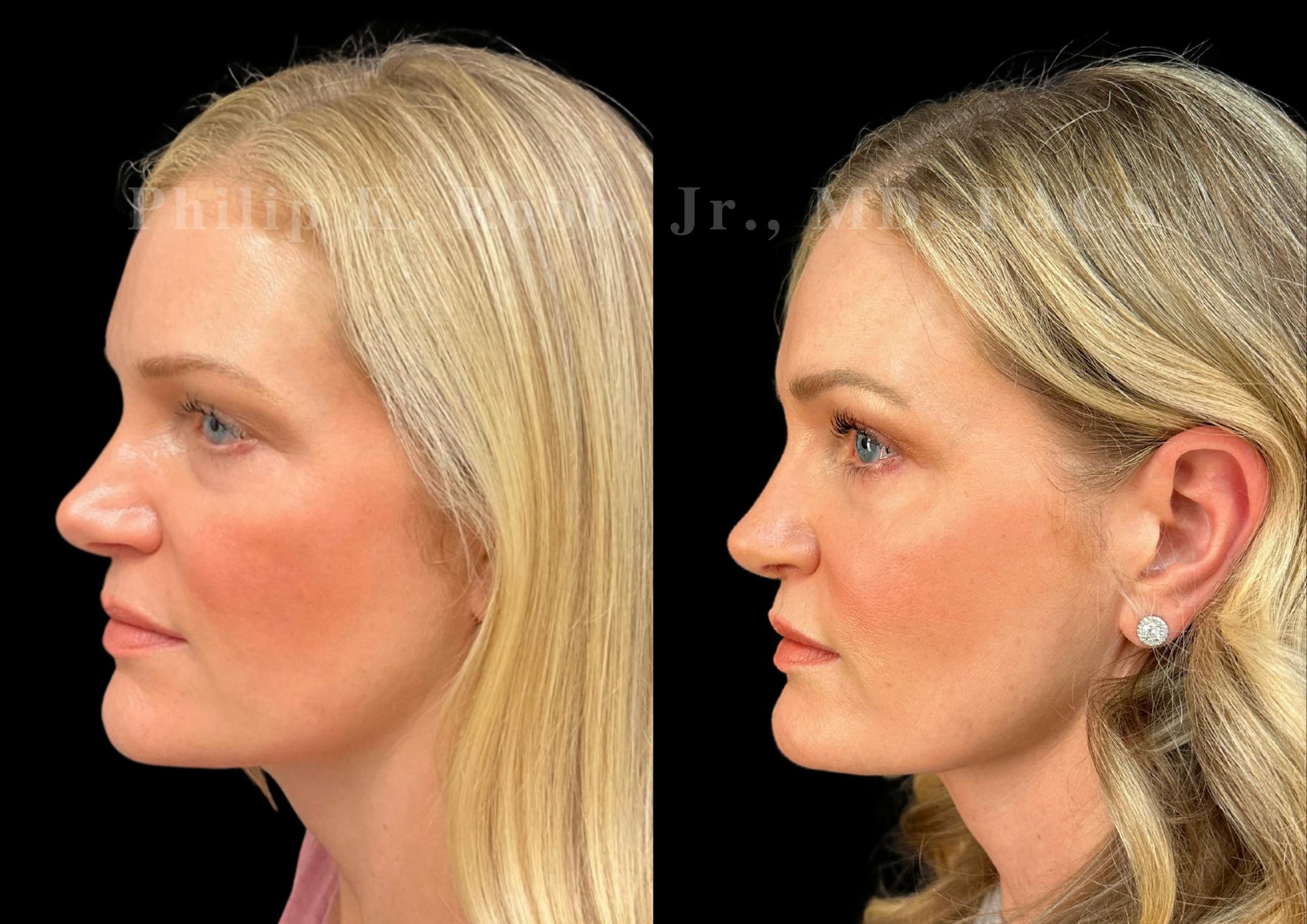 Ultrasonic Rhinoplasty Before & After Gallery - Patient 146426 - Image 5