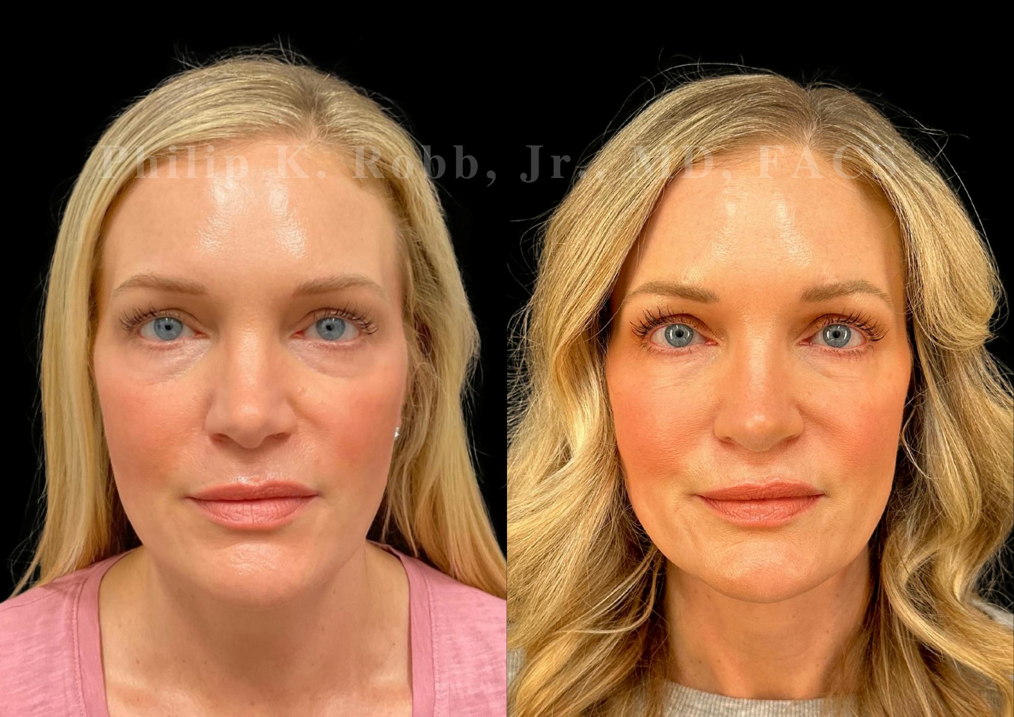 Ultrasonic Rhinoplasty Before & After Gallery - Patient 146426 - Image 3
