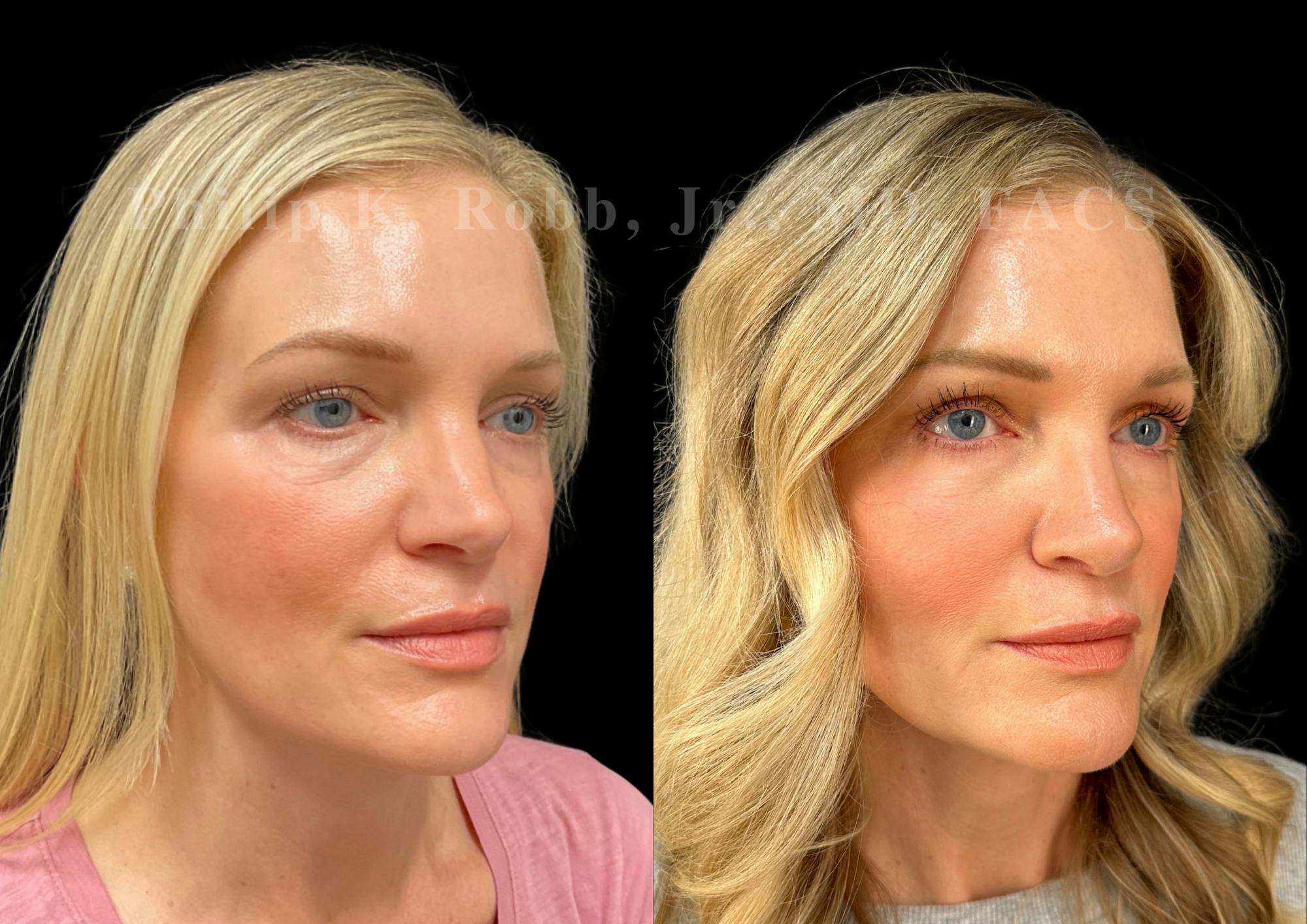 Ultrasonic Rhinoplasty Before & After Gallery - Patient 146426 - Image 2