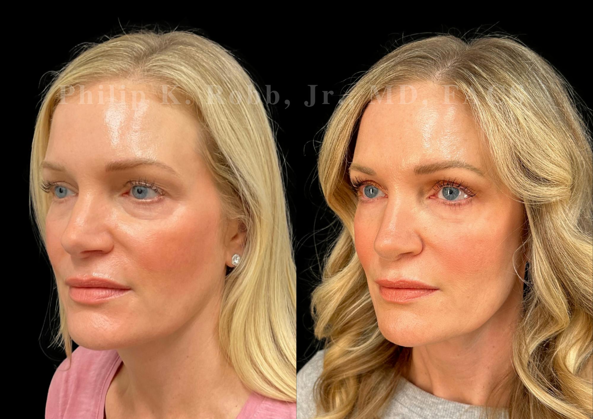 Ultrasonic Rhinoplasty Before & After Gallery - Patient 146426 - Image 4
