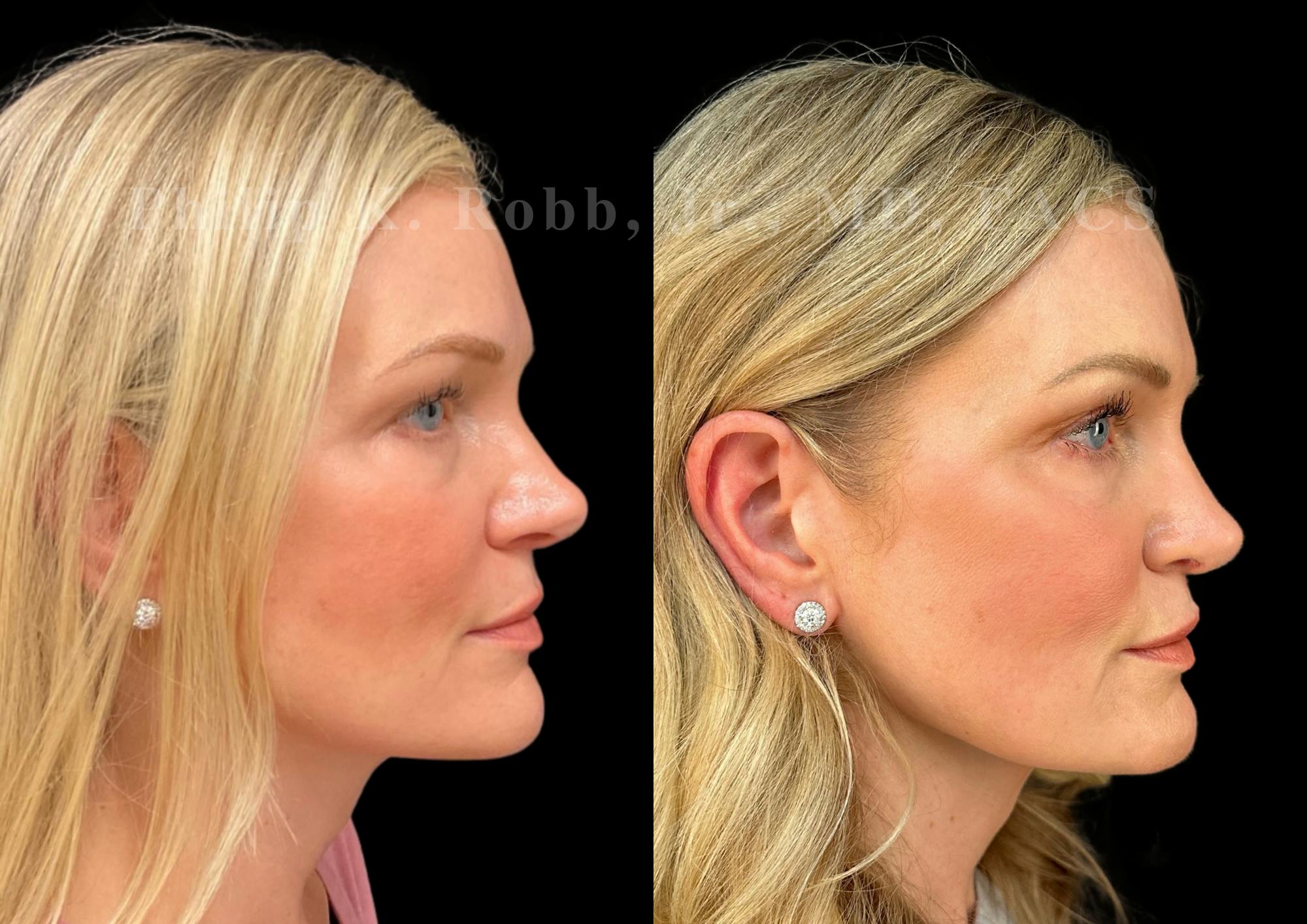 Ultrasonic Rhinoplasty Before & After Gallery - Patient 146426 - Image 1