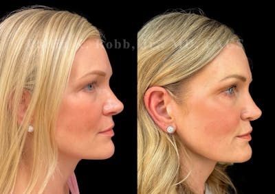 Ultrasonic Rhinoplasty Before & After Gallery - Patient 146426 - Image 1