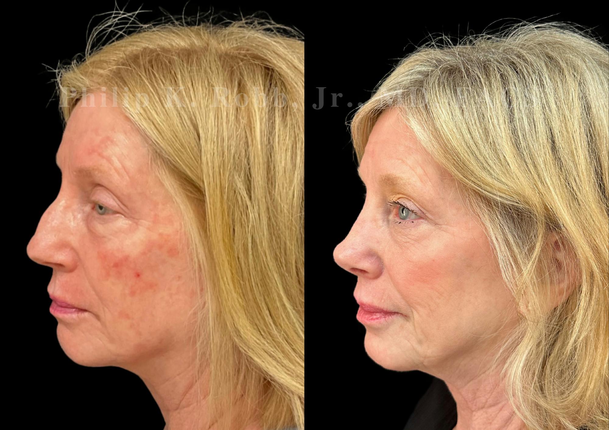 Ultrasonic Rhinoplasty Before & After Gallery - Patient 247379 - Image 5