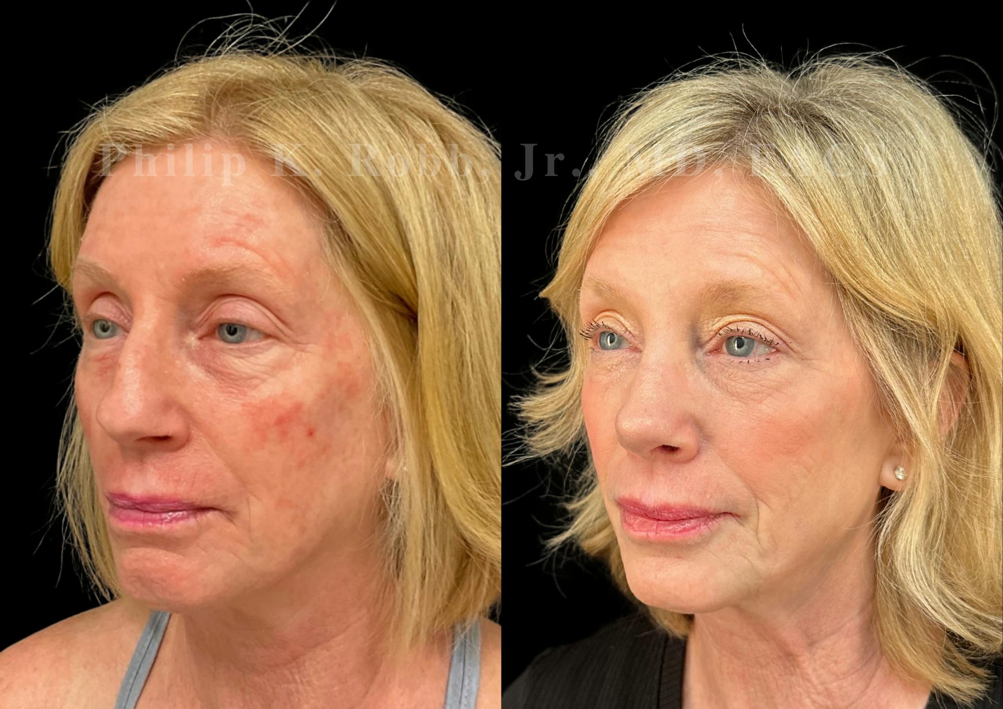 Ultrasonic Rhinoplasty Before & After Gallery - Patient 247379 - Image 4