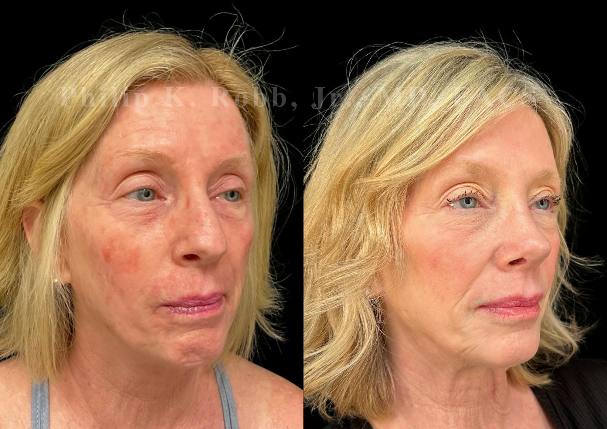 Ultrasonic Rhinoplasty Before & After Gallery - Patient 247379 - Image 2