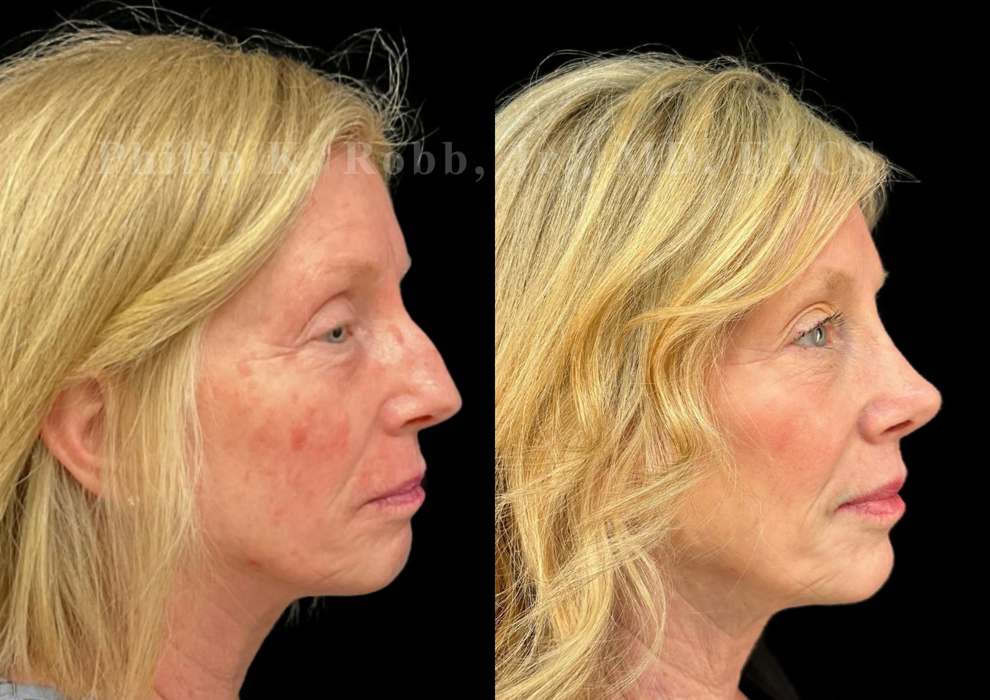 Ultrasonic Rhinoplasty Before & After Gallery - Patient 247379 - Image 1