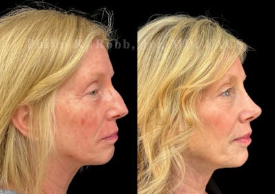 Ultrasonic Rhinoplasty Before & After Gallery - Patient 247379 - Image 1