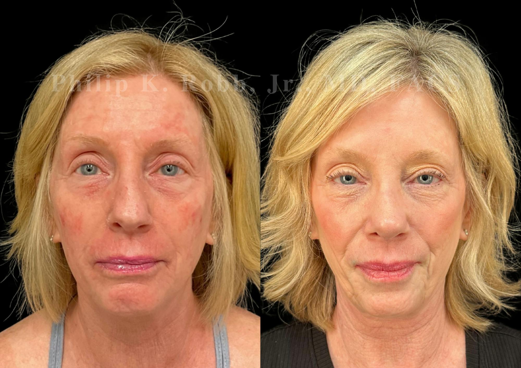 Ultrasonic Rhinoplasty Before & After Gallery - Patient 247379 - Image 3