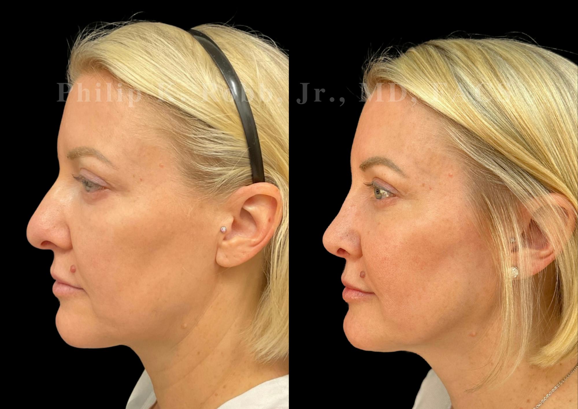 Ultrasonic Rhinoplasty Before & After Gallery - Patient 349185 - Image 5