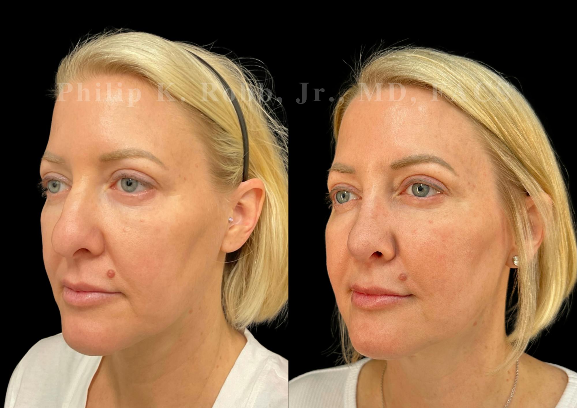 Ultrasonic Rhinoplasty Before & After Gallery - Patient 349185 - Image 4