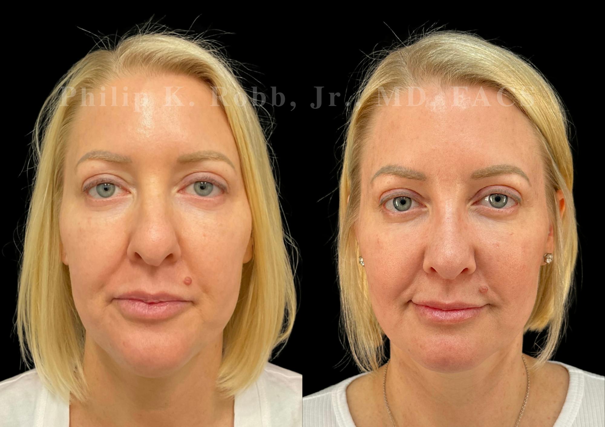 Ultrasonic Rhinoplasty Before & After Gallery - Patient 349185 - Image 3