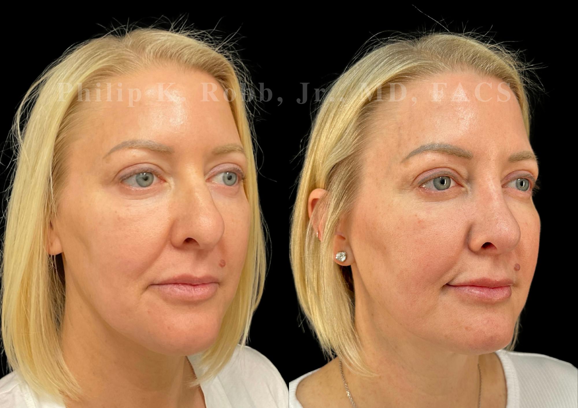 Ultrasonic Rhinoplasty Before & After Gallery - Patient 349185 - Image 2