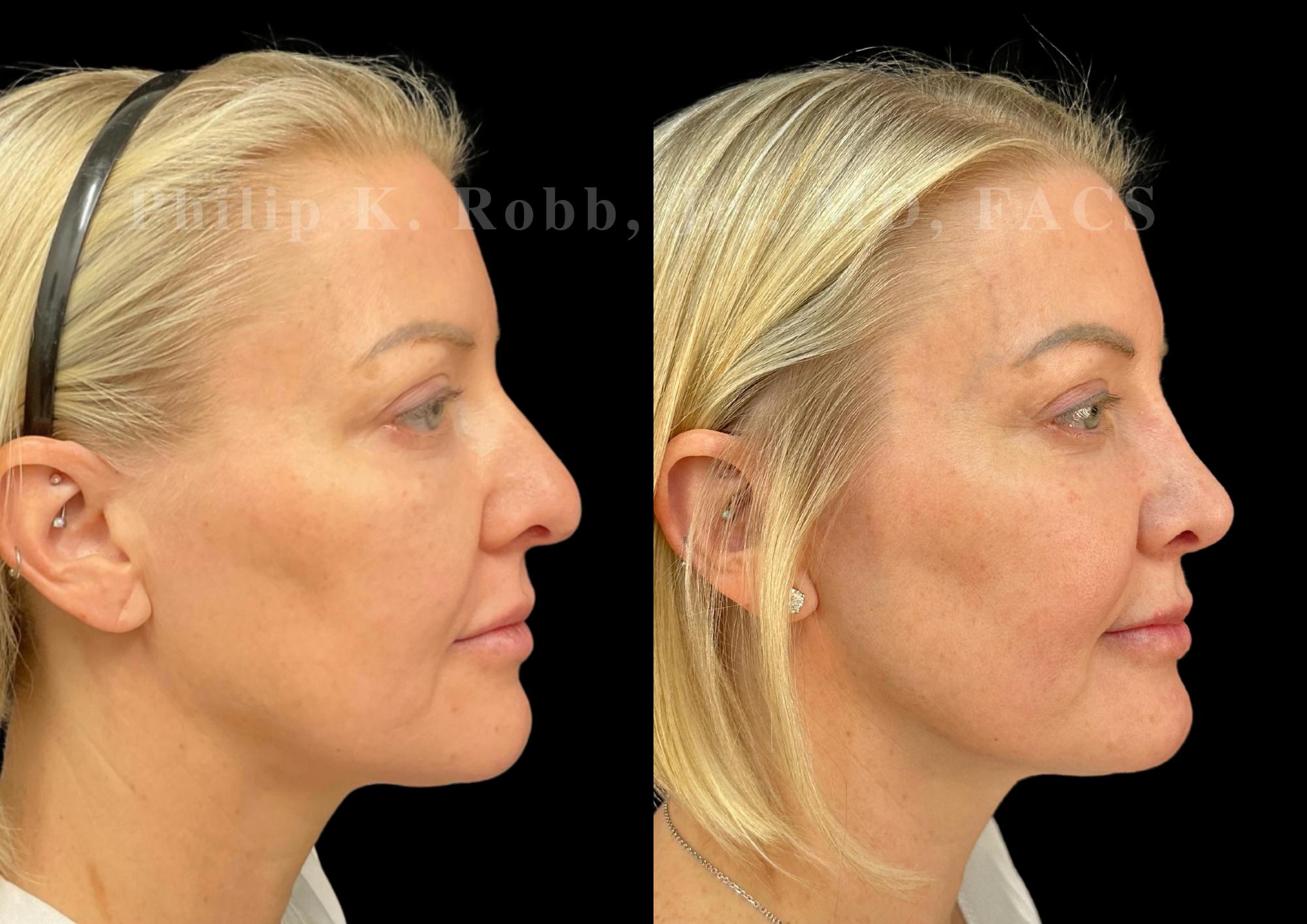 Ultrasonic Rhinoplasty Before & After Gallery - Patient 349185 - Image 1