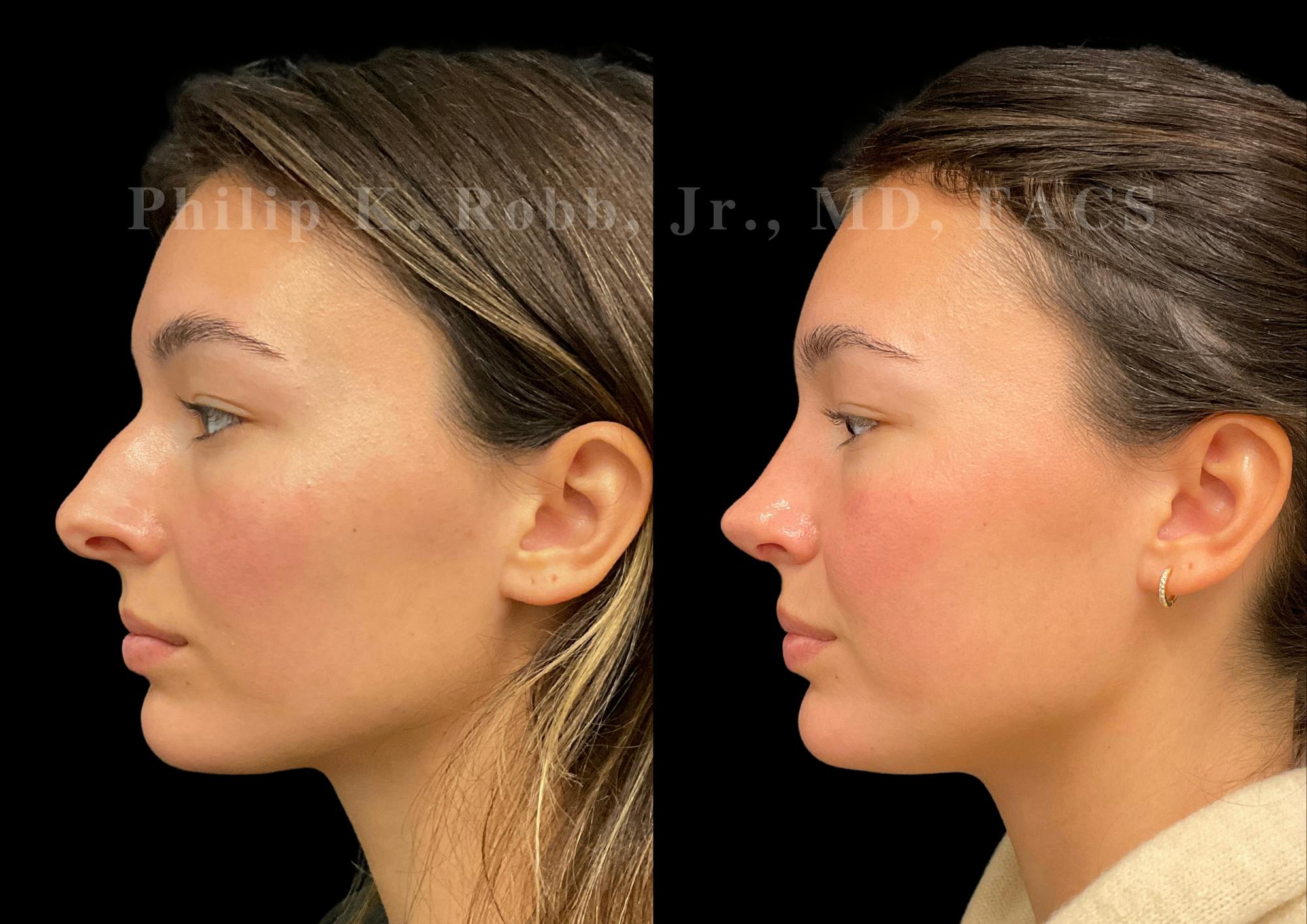 Ultrasonic Rhinoplasty Before & After Gallery - Patient 355776 - Image 5