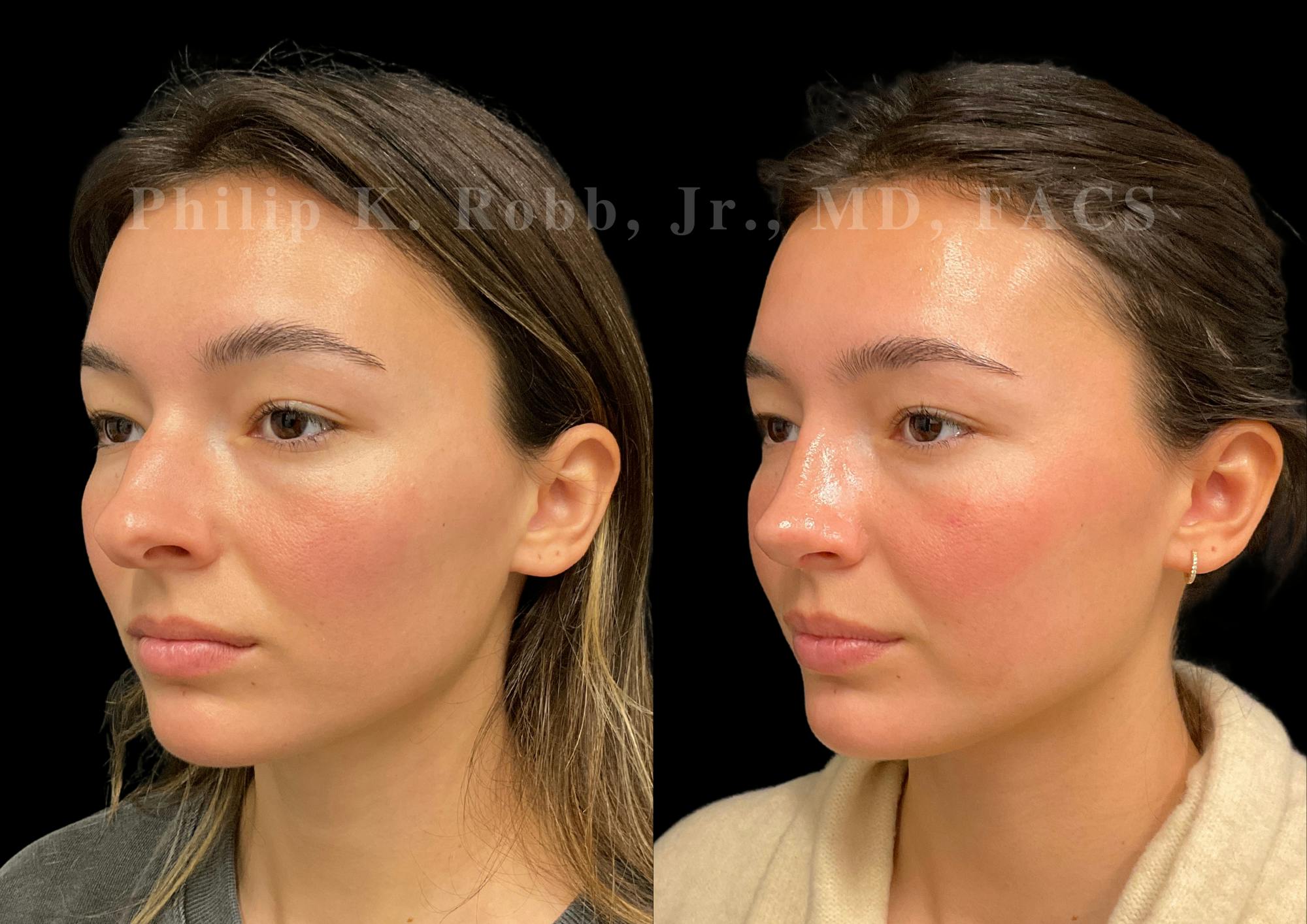 Ultrasonic Rhinoplasty Before & After Gallery - Patient 355776 - Image 4