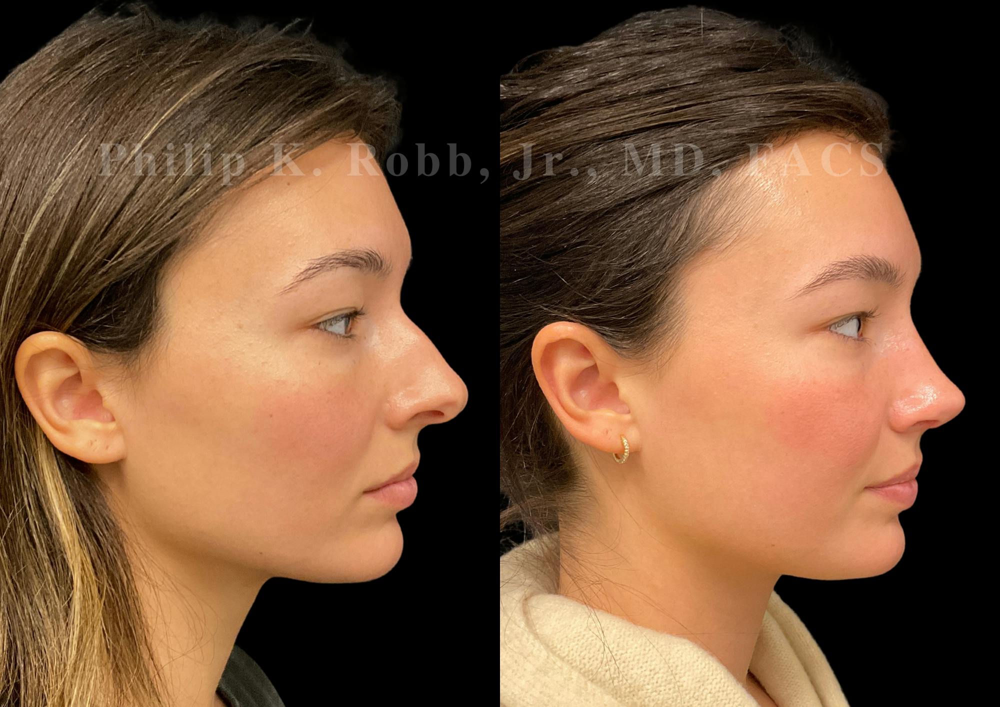 Ultrasonic Rhinoplasty Before & After Gallery - Patient 355776 - Image 1