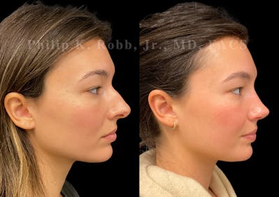 Ultrasonic Rhinoplasty Before & After Gallery - Patient 355776 - Image 1