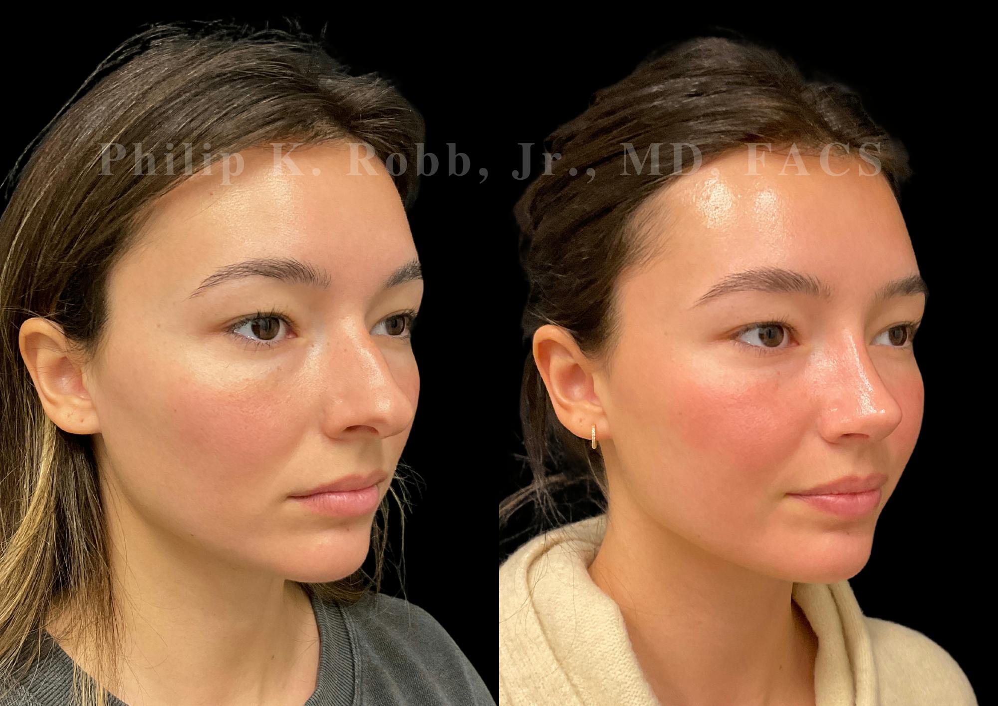 Ultrasonic Rhinoplasty Before & After Gallery - Patient 355776 - Image 2