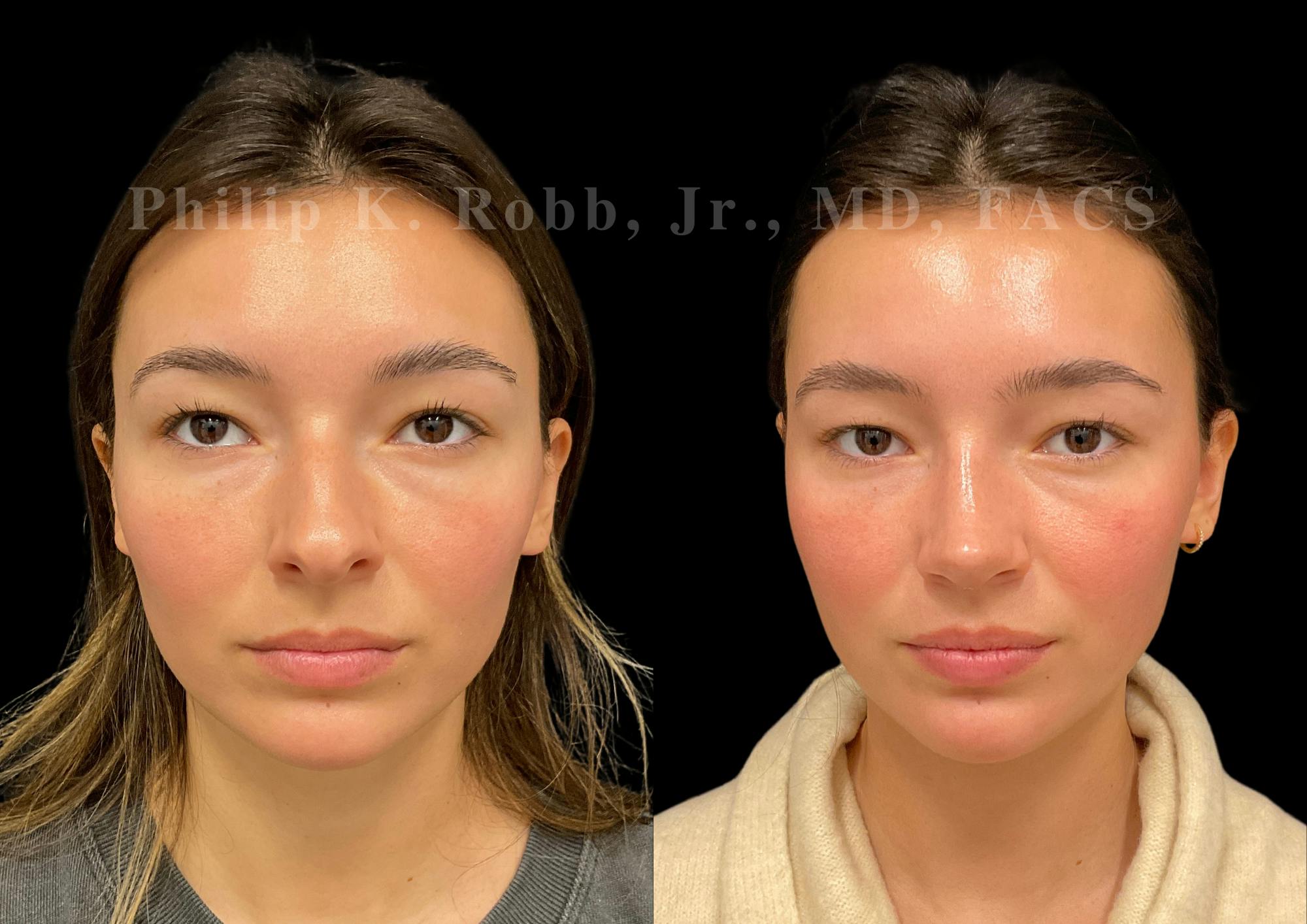 Ultrasonic Rhinoplasty Before & After Gallery - Patient 355776 - Image 3