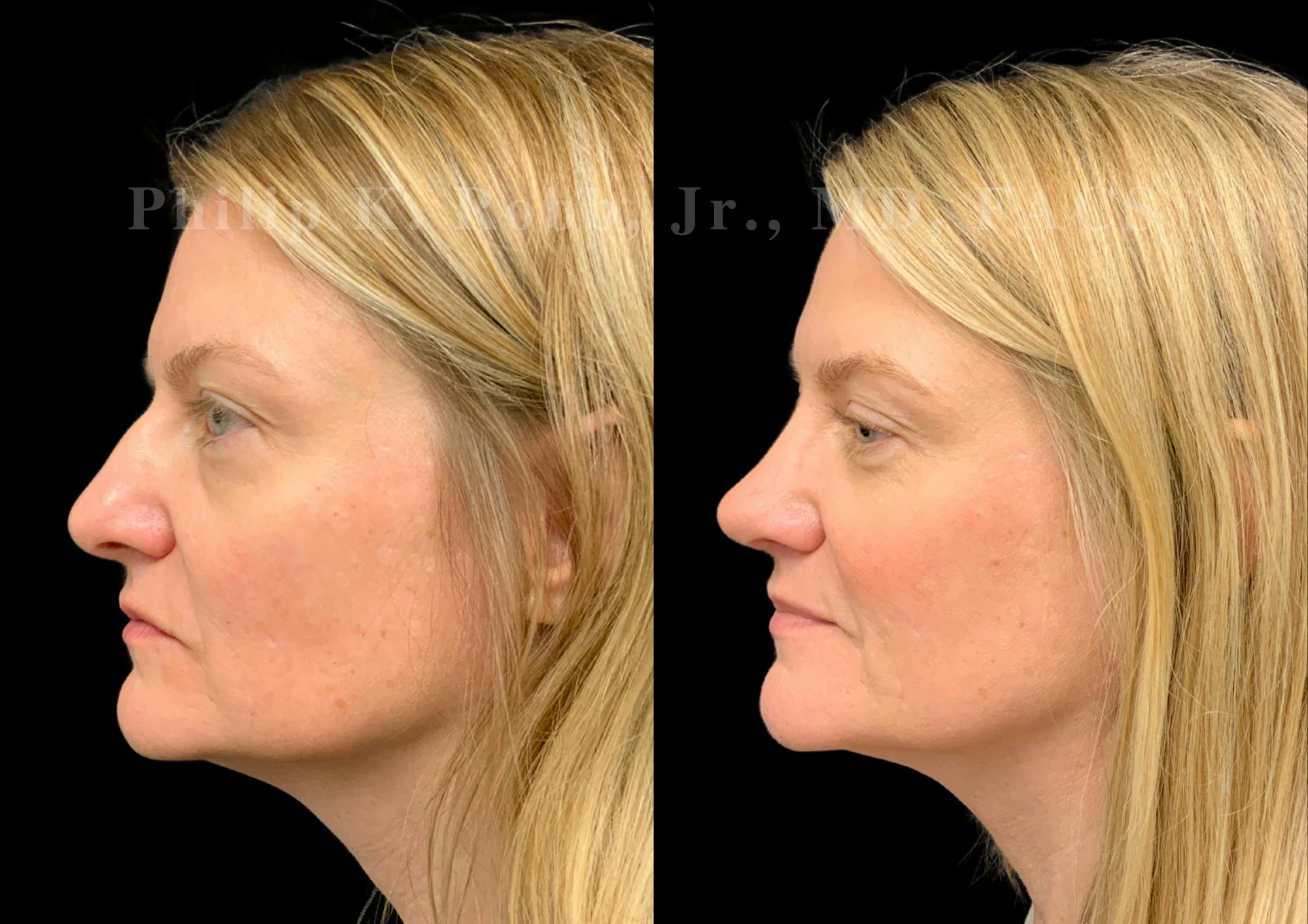 Ultrasonic Rhinoplasty Before & After Gallery - Patient 924201 - Image 5