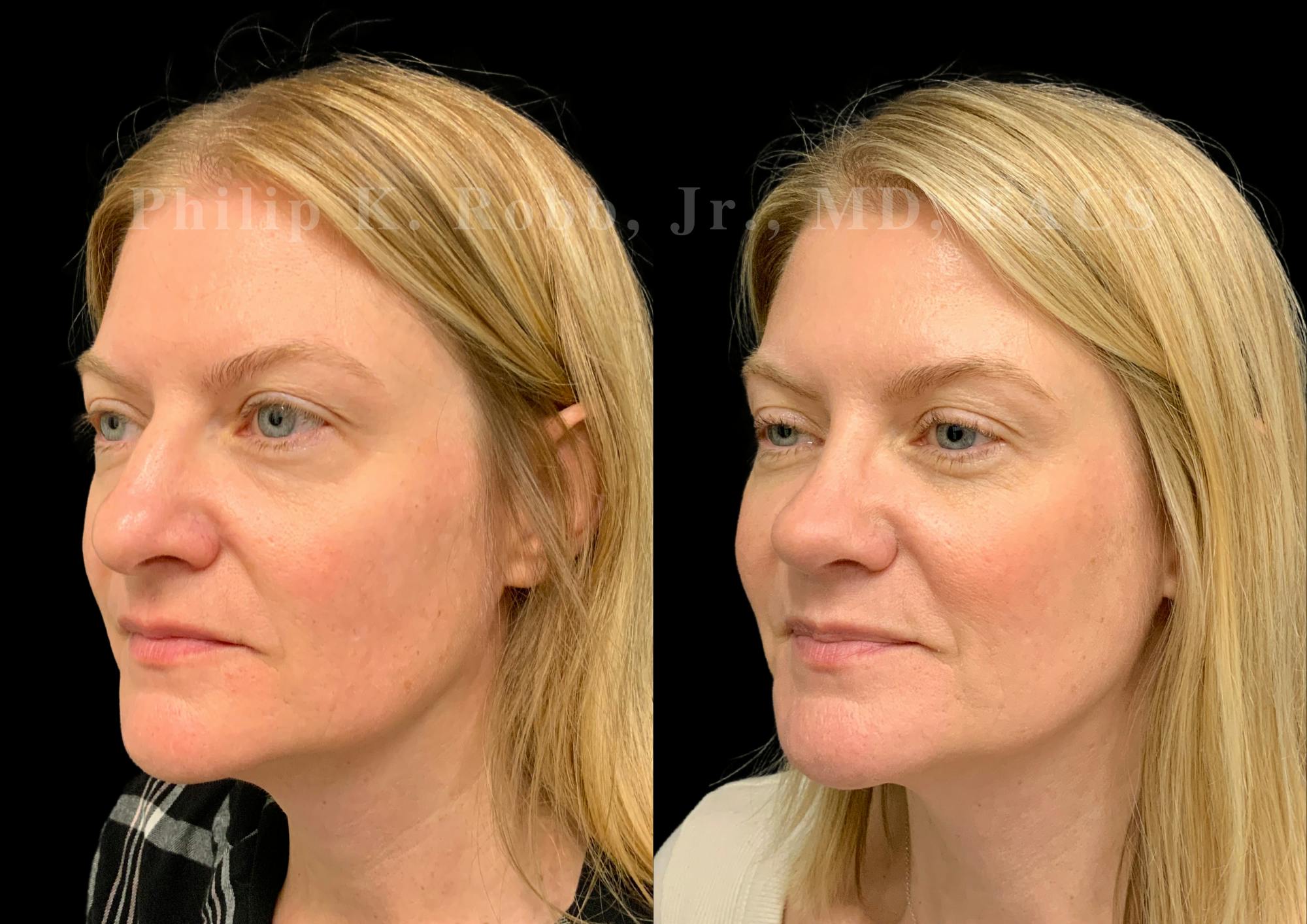 Ultrasonic Rhinoplasty Before & After Gallery - Patient 924201 - Image 4