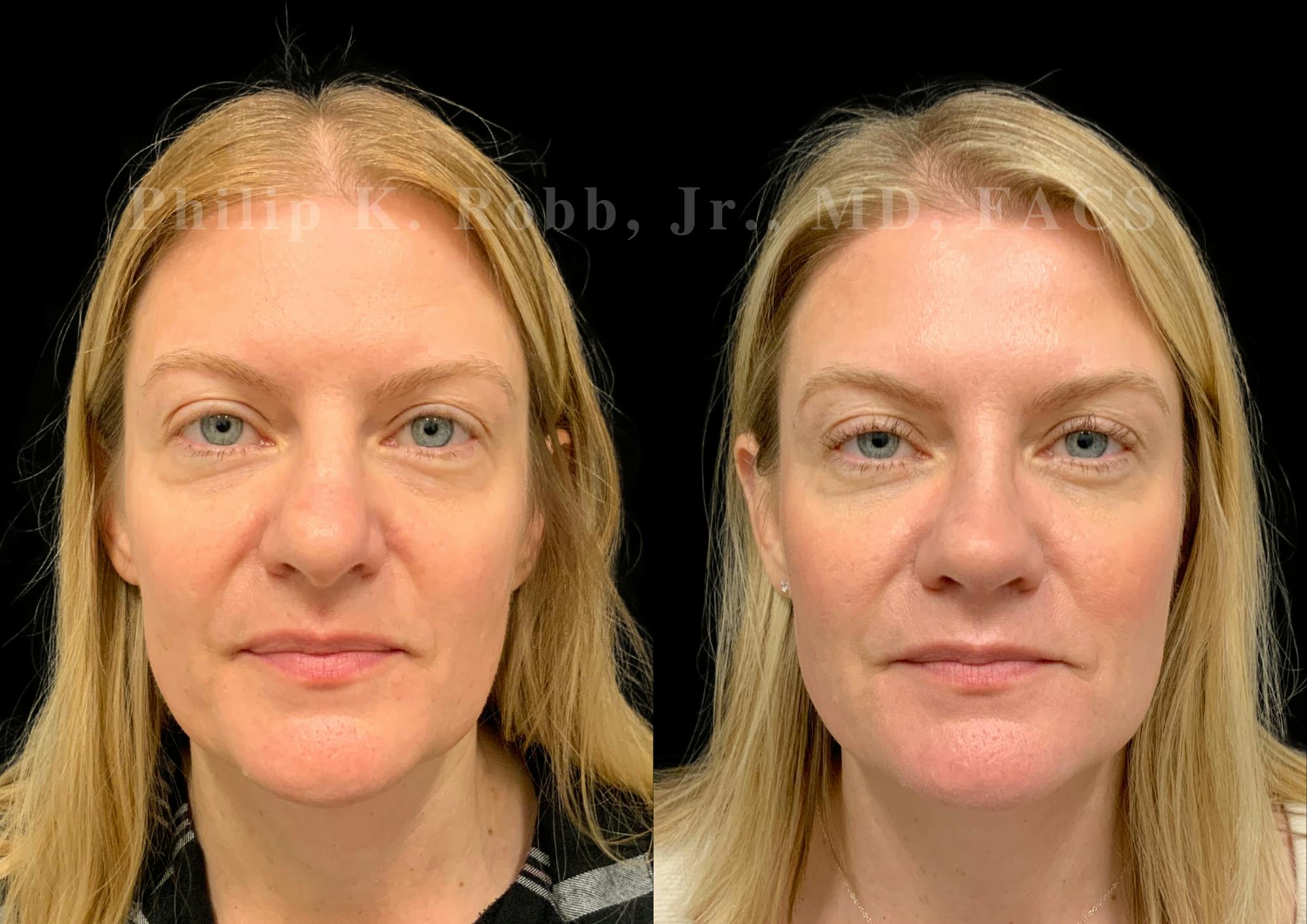 Ultrasonic Rhinoplasty Before & After Gallery - Patient 924201 - Image 3