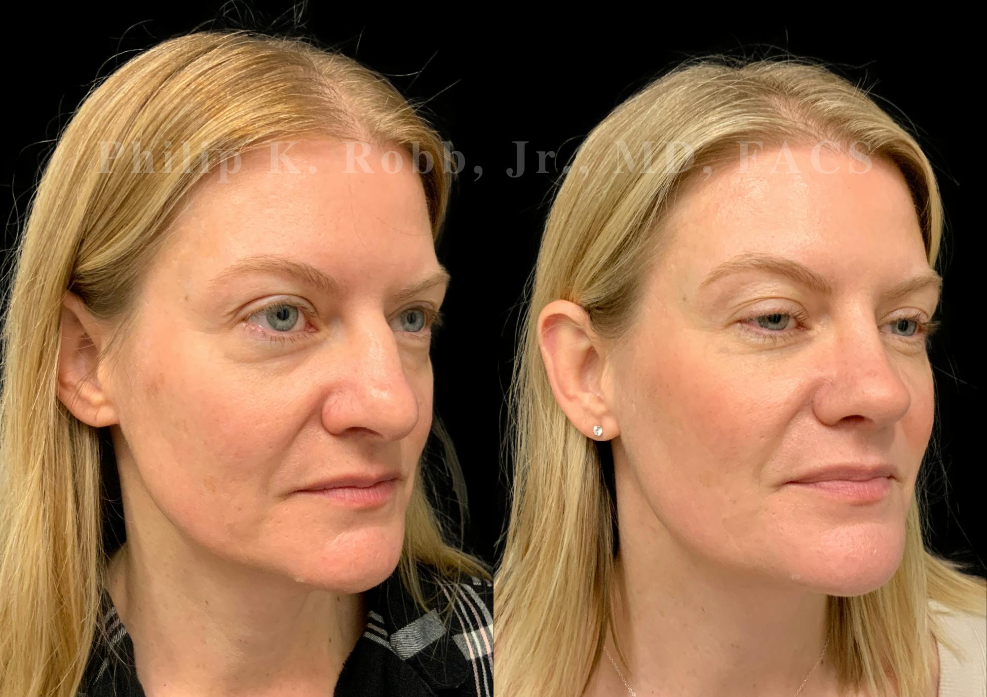 Ultrasonic Rhinoplasty Before & After Gallery - Patient 924201 - Image 2